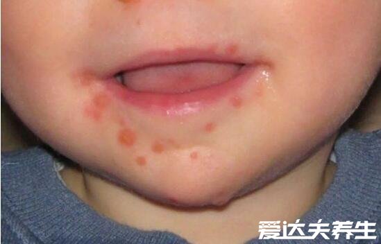 小孩口足手病轻微图片，手足口出现红色丘疹伴随感冒症状
