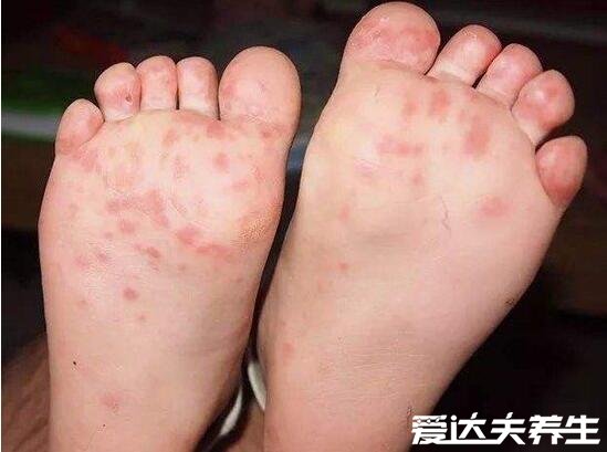 小孩口足手病轻微图片，手足口出现红色丘疹伴随感冒症状