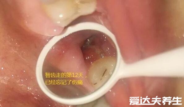 智齿拔牙后窟窿恢复图，4个过程3个月时间可完全愈合
