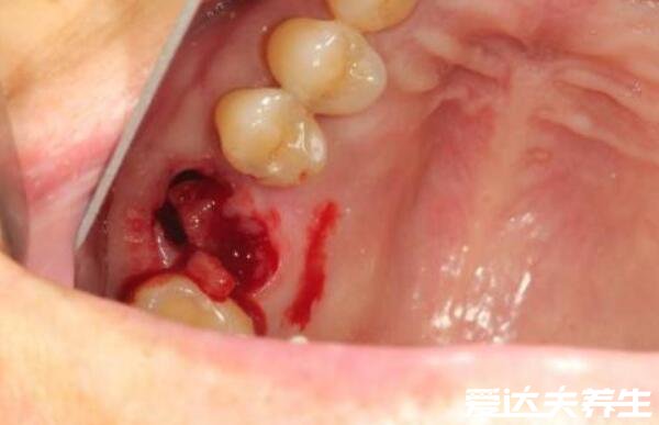 智齿拔牙后窟窿恢复图，4个过程3个月时间可完全愈合