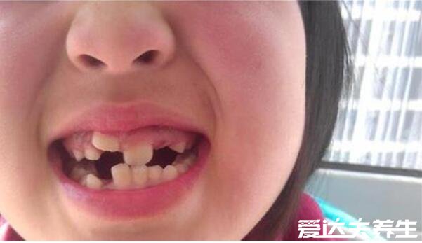 详细儿童换牙顺序图，6岁左右换乳牙长恒牙(5大注意事项)