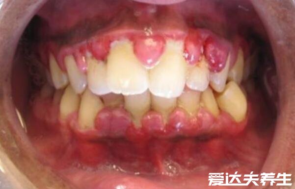 早期牙龈炎图片及症状，5大早期症状牙龈出血需要警惕