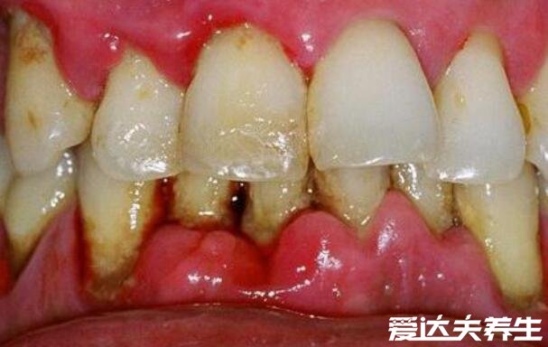 早期牙龈炎图片及症状，5大早期症状牙龈出血需要警惕