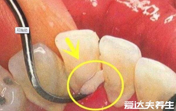 牙结石可以自己抠掉吗，不要自己扣定期洗牙才是最安全的