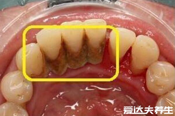 牙结石可以自己抠掉吗，不要自己扣定期洗牙才是最安全的