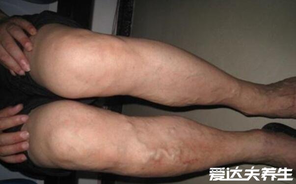 早期小腿静脉曲张图片症状，突出皮肤的血管像蚯蚓一样