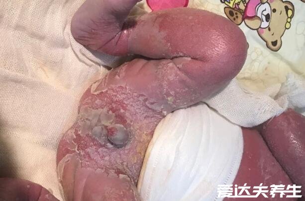火棉胶婴儿长大后图片，少部分患者可以恢复正常皮肤