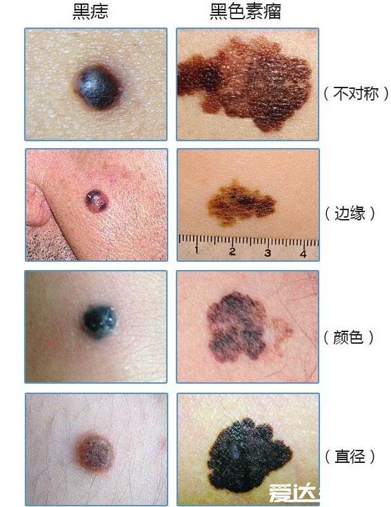 黑色素瘤早期症状图片，通过abcd法轻松辨别普通痣和黑色素瘤
