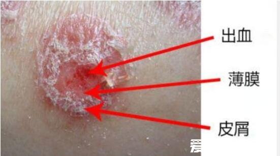 不同类型的银屑病图片，认清鳞屑/薄膜/出血三大标志症状
