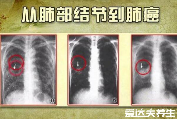 肺结节10个人9个人有吗，不准确但发病率很高(警惕肺癌)