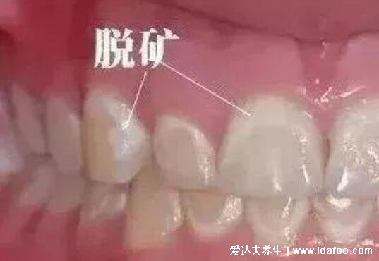 牙釉质脱落早期图片及症状，有浅小的窝沟为淡黄色