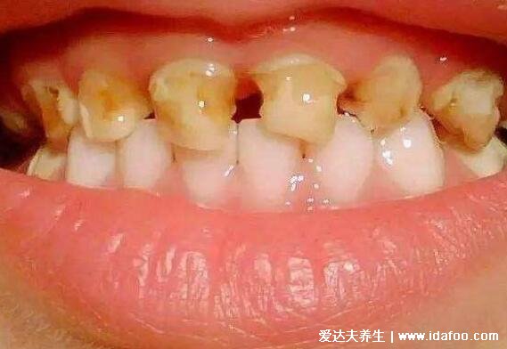 牙釉质脱落早期图片及症状，有浅小的窝沟为淡黄色