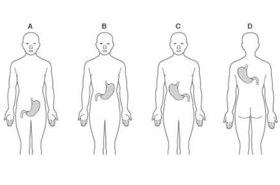 胃在什么位置图片，位于腹腔左上方/胸骨下方的凹陷处