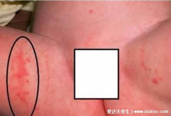 尿布疹图片症状及注意事项，俗称红屁股分为三个阶段