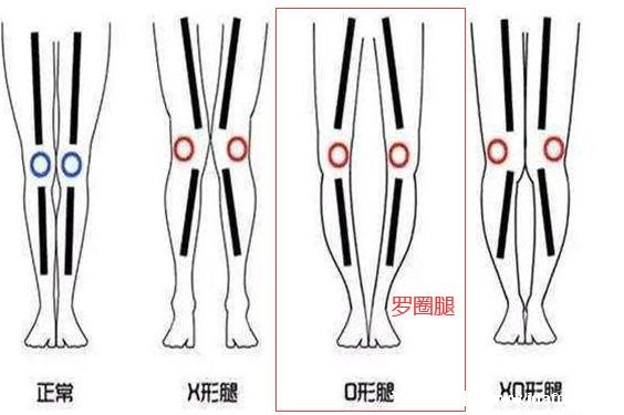 罗圈腿图片症状及矫正方法，呈膝盖外翻可通过运动改善
