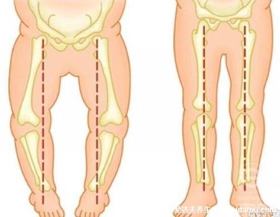 罗圈腿图片症状及矫正方法，呈膝盖外翻可通过运动改善