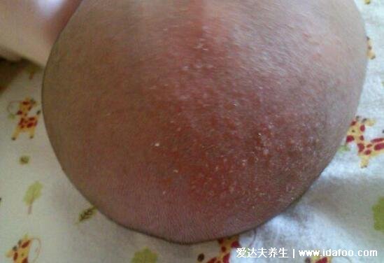 新生儿湿疹图片症状及护理方法，呈明显红肿有强烈瘙痒感
