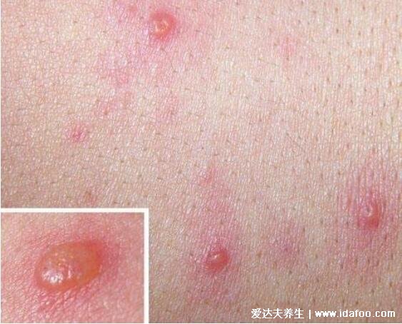 水痘刚开始的样子图片，红色丘疹转变为全透明的水疱要注意