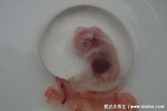 药流后孕囊掉下来的图片，呈椭圆形乳白色肉样组织