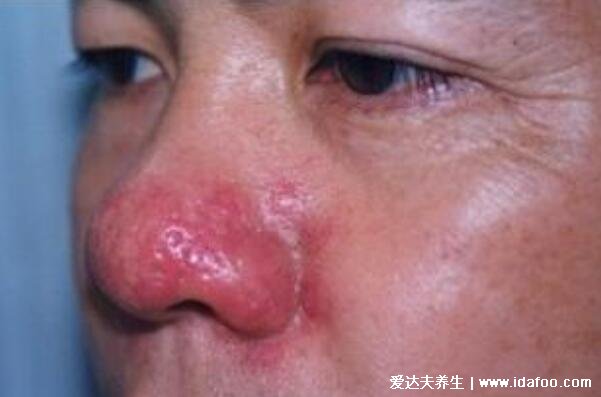 最丑的几种鼻子图片，鼻子太影响颜值和气质了(5种公认丑鼻型)