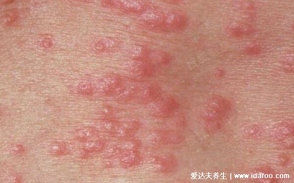 床上螨虫咬的症状图片，皮肤出现红色丘疹在夜间瘙痒难耐