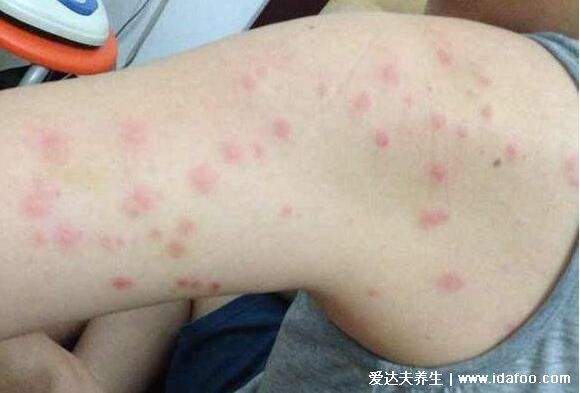 床上螨虫咬的症状图片，皮肤出现红色丘疹在夜间瘙痒难耐