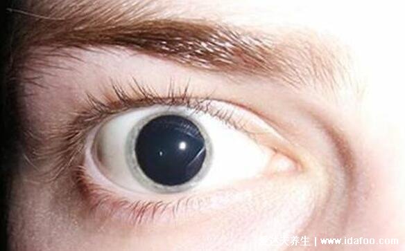正常瞳孔和瞳孔放大图，瞳孔放大超过两个小时居然会导致脑死亡