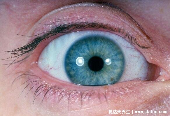 正常瞳孔和瞳孔放大图，瞳孔放大超过两个小时居然会导致脑死亡
