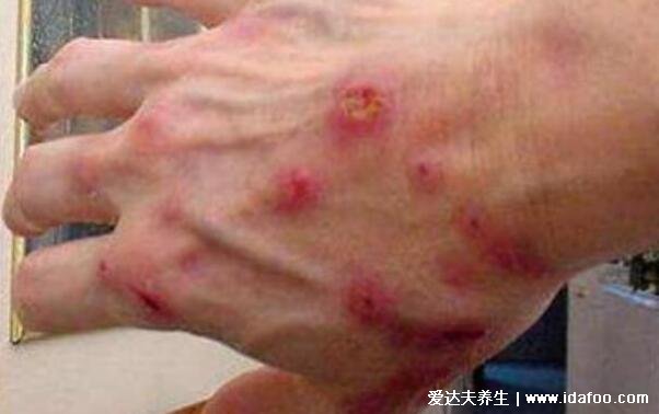 蜱虫咬人后的伤口图，出现红肿瘀斑或是黑痣样(严重会丧命)