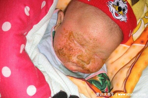 小儿湿疹图片及症状，干燥型湿疹最痒不要搔抓