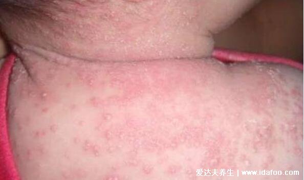 小儿湿疹图片及症状，干燥型湿疹最痒不要搔抓