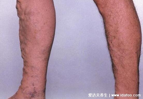早期小腿静脉曲张图片及症状，可见明显血管扩张有瘙痒感