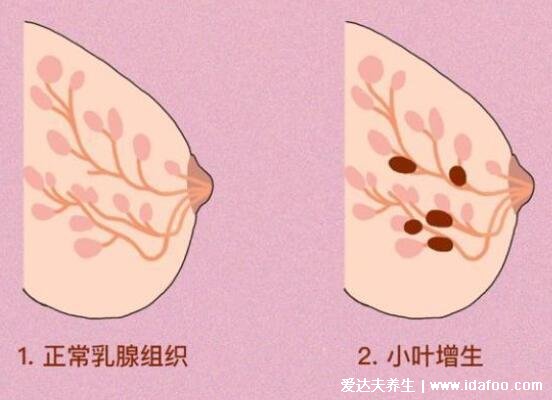 乳腺增生和正常乳腺图片手感，一个柔软一个异物感强烈区别很大