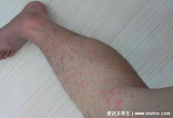 荨麻疹图片和症状，呈条状风团/皮肤划痕症(胆小勿入)