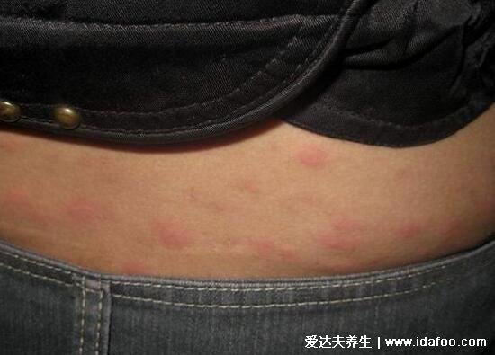 荨麻疹图片和症状，呈条状风团/皮肤划痕症(胆小勿入)