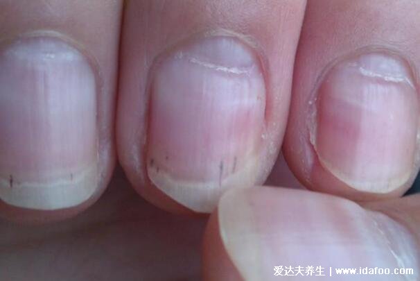 手指甲分层是怎么回事是缺什么，4大原因要警惕得了灰指甲(图片)