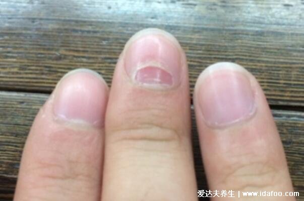 手指甲分层是怎么回事是缺什么，4大原因要警惕得了灰指甲(图片)