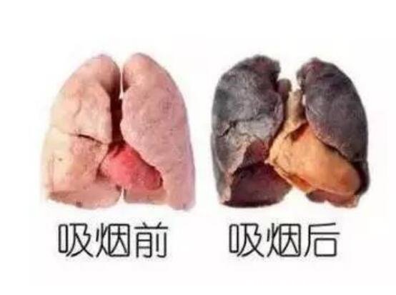 抽了一年电子烟的肺部图片，与普通香烟对比危害还要大