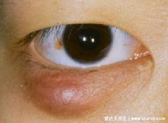 麦粒肿早期图片症状及怎么消除，俗称针眼可使用抗生素消除