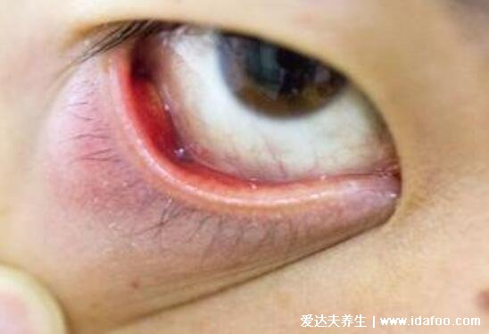 麦粒肿早期图片症状及怎么消除，俗称针眼可使用抗生素消除