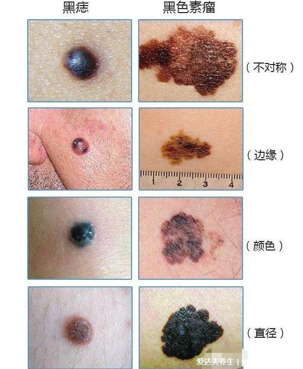 黑色素瘤早期症状图片，四招教你判别黑色素瘤和普通痣的区别