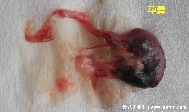 流产孕囊掉下来的图片，粉白色透明圆状物和血块区别大(胆小慎入)