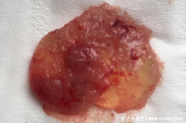 流产孕囊掉下来的图片，粉白色透明圆状物和血块区别大(胆小慎入)
