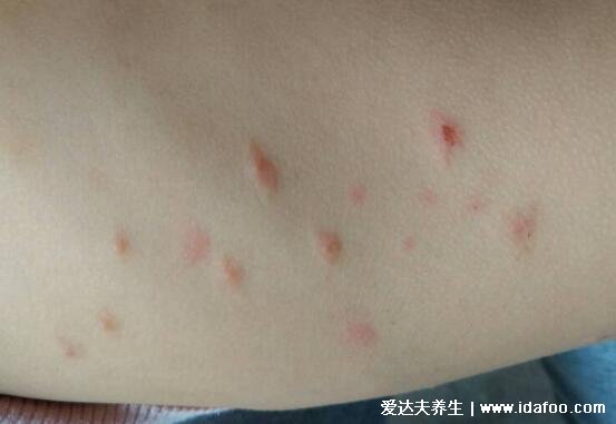 水痘图片大全及初期症状，多为红色基地疱疹呈向心性分布