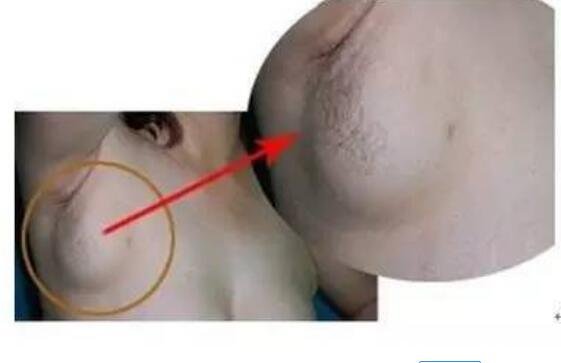 腋下淋巴癌早期症状图片，腋下红肿有明显瘙痒感会扩散