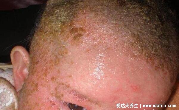 湿疹图片初期症状图片，四种类型的湿疹干燥型最痒(不要抓小心感染)