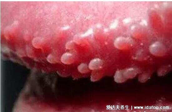 尖湿锐尤典型早期图片及症状，起初淡红色小丘疹3-5天长成菜花状疣体