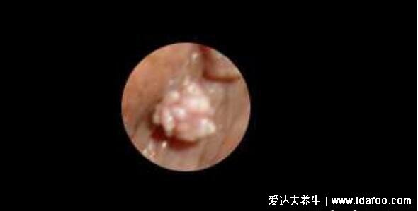 尖湿锐尤典型早期图片及症状，起初淡红色小丘疹3-5天长成菜花状疣体