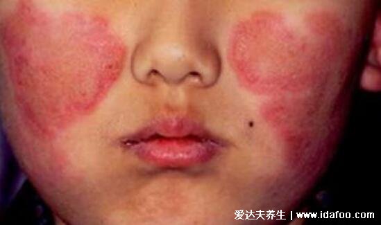系统性红斑狼疮图片，脸颊长鲜红的斑疹像蝴蝶一样(有灼痛感)