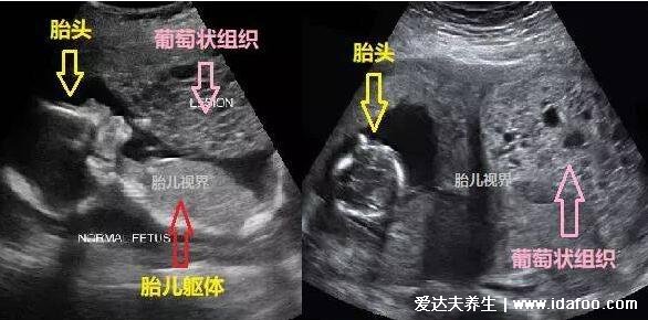 葡萄胎是什么形成原因与症状，子宫内长满葡萄样的水泡(图片慎点)
